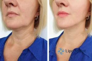 Double chin before and after Hi-Fu treatment 4 Book your double chin treatment Wooburn Green today! We are here to help!