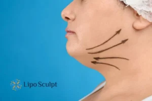 Double chin before and after Hi-Fu treatment 3 Boost your confidence with a Double chin treatment Wooburn Green