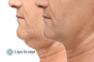 Double chin before and after Hi-Fu treatment 2 Double chin treatment Wooburn Green from Lipo Sculpt - feel more confident today!