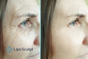 How to Fight Aging Symptoms 2 Do you want to Fight Aging Symptoms Wooburn Green? Contact Lipo Sculpt today!