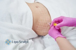 Are The Results From Aqualyx Permanent? 1 Do you want to know how long Aqualyx Wooburn Green results last?