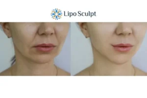 Explaining Total Skin Tightening Treatment And What It Can Do For You 2 Do you want to boost your self confidence? Give Morpheus8 Wooburn Green a try today!