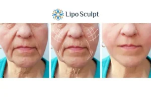 Explaining Total Skin Tightening Treatment And What It Can Do For You 3 Boost your confidence with Morpheus8 Wooburn Green call our team today!