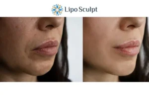 Explaining Total Skin Tightening Treatment And What It Can Do For You 4 Morpheus8 Wooburn Green the best results - call our team today!