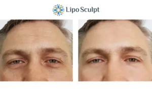 Explaining Total Skin Tightening Treatment And What It Can Do For You 6 Morpheus8 Wooburn Green book in today to find out more!