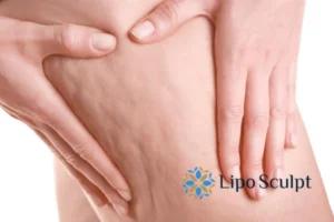 CoolSculpting for Legs: The Innovative Approach to Redefining Your Legs 5 Start your journey today book your coolsculpting treatment Wooburn Green online today!