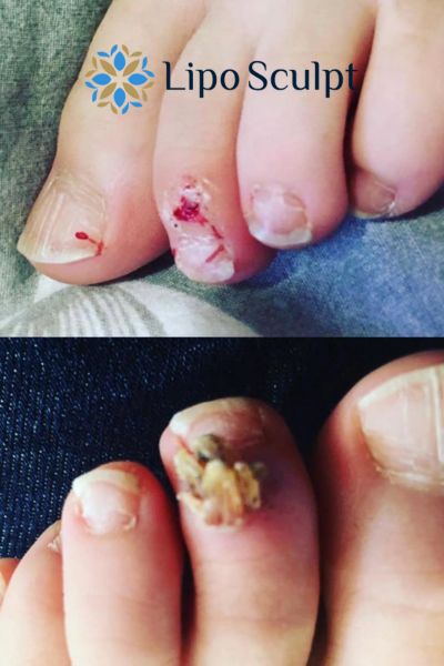 Wart removal customer results from Lipo Sculpt Wooburn Green