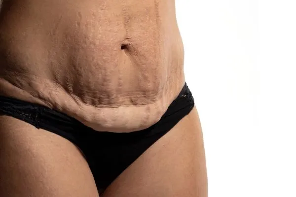 Lost the Weight but Not the Loose Skin? 1 image of womans stomach after weight loss showing loose skin Wooburn Green